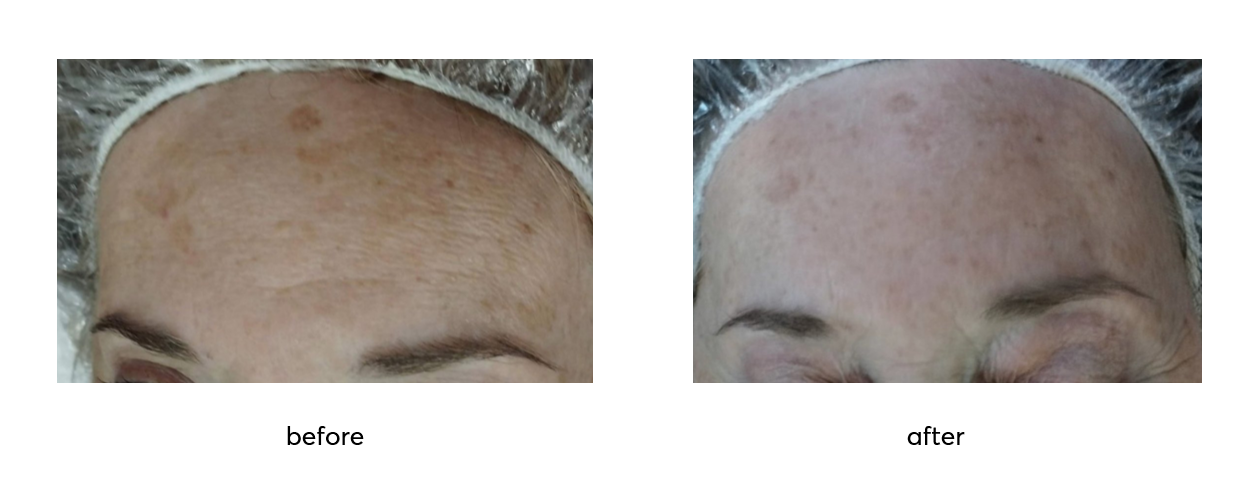 Rejuvin_Before-After-3-Applications_2