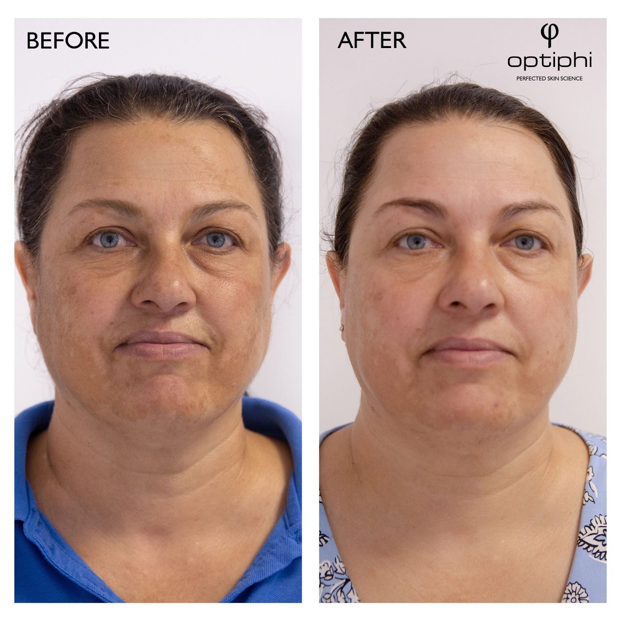 vorhernachher-RETINOL-PEELING DELTA Quadration Peeling 3 sessions /professionelle Behandlungen