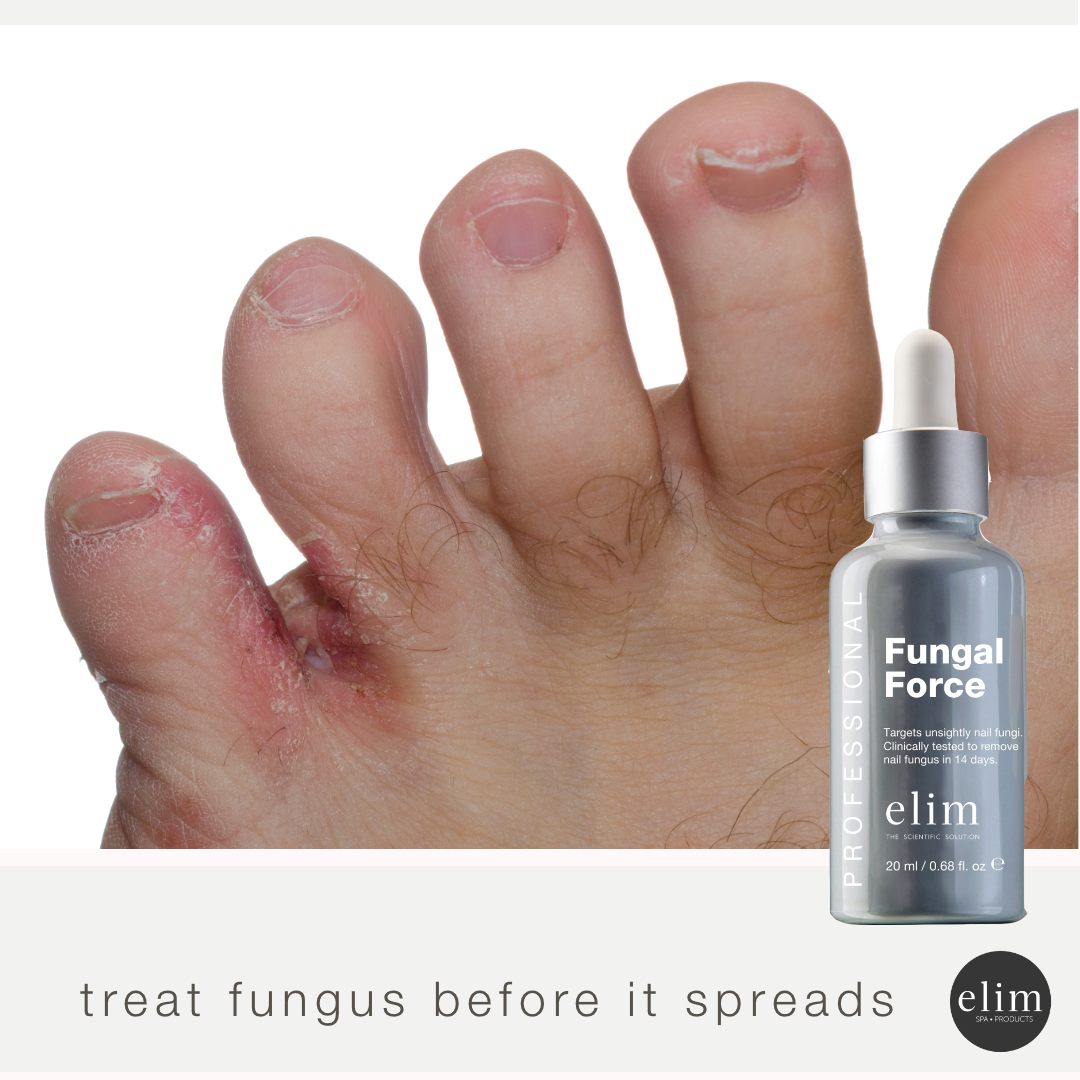 fungal-infections