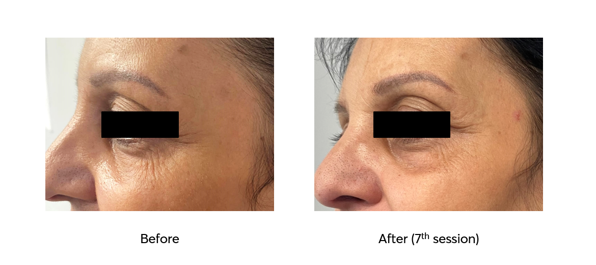 Ameson-Mesopeel-Rejuvenation-Before-After-7-Sessions-2