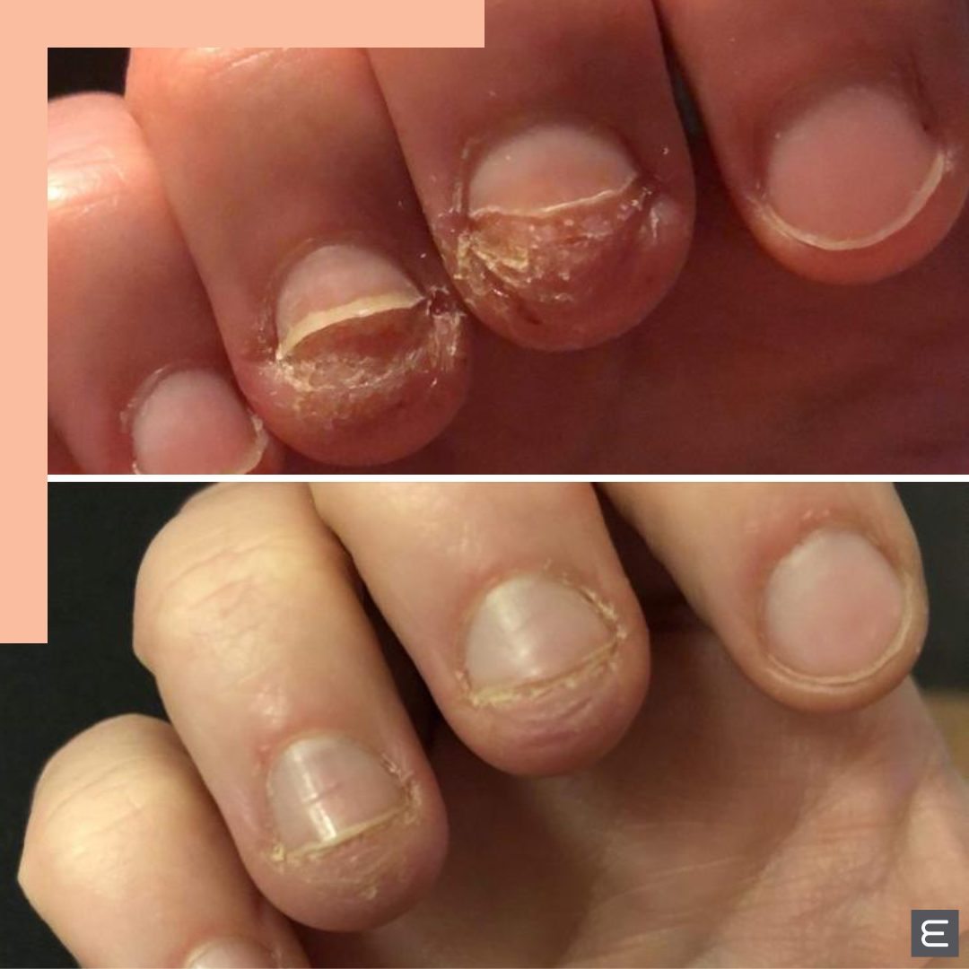 nail-fungus-fungal-force-treatment