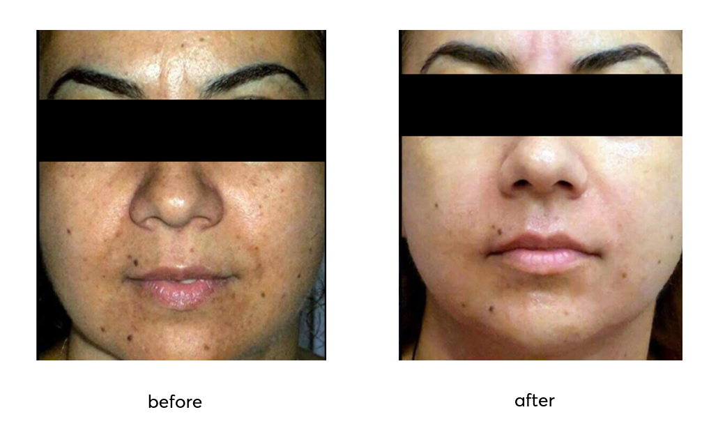 Brightening-before-after-10-sessions