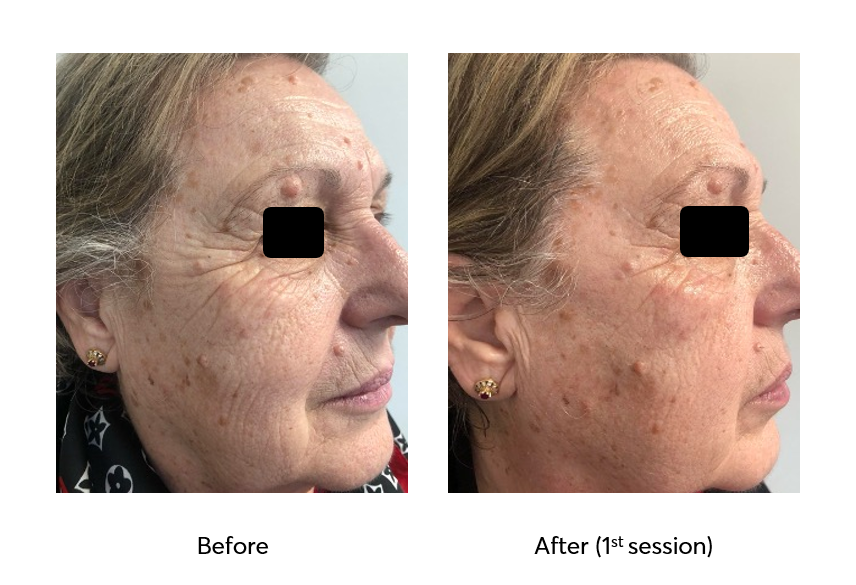 Caviar-Nourishing-Therapy-Before-After-1-Session-1