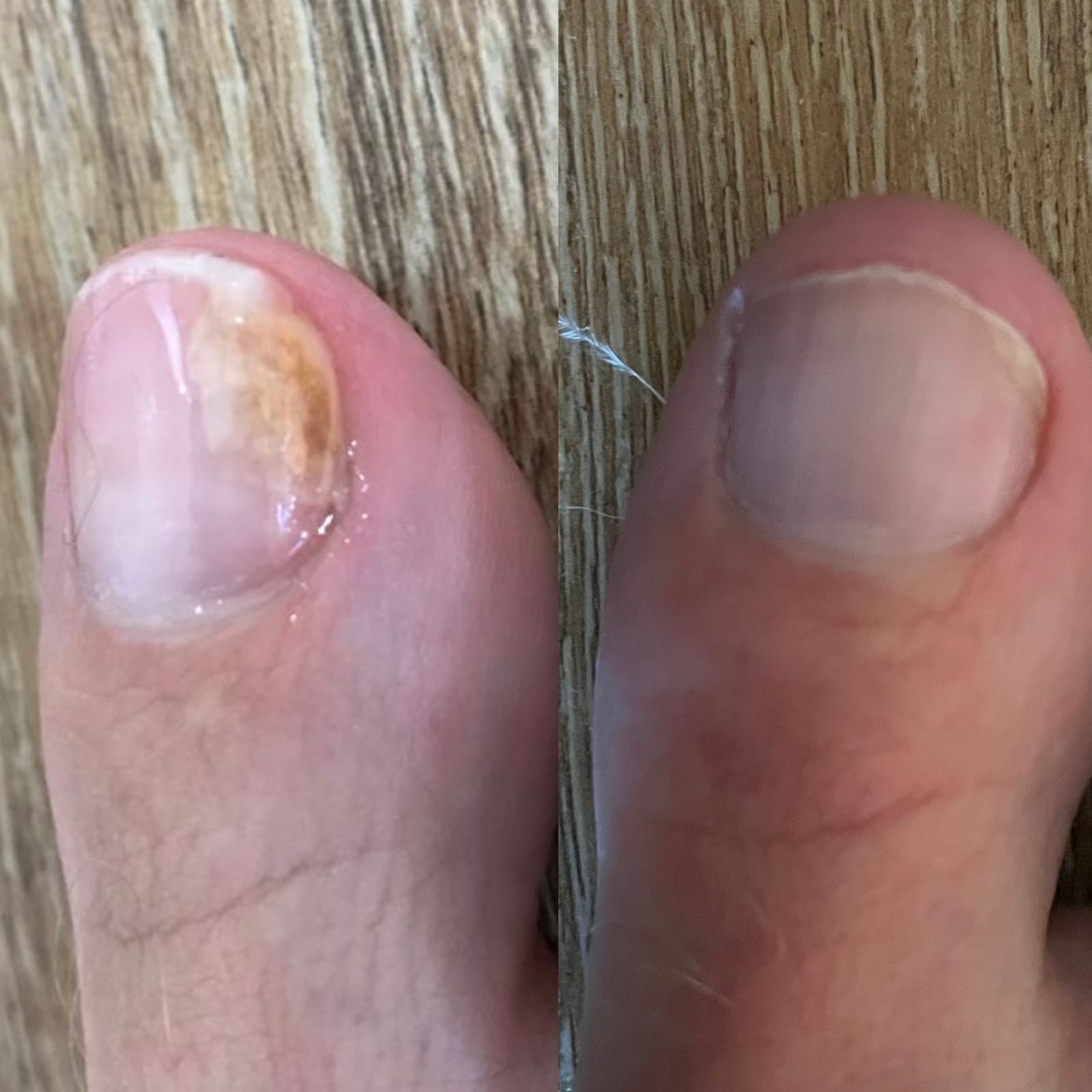Nail-Fungus-Before-After