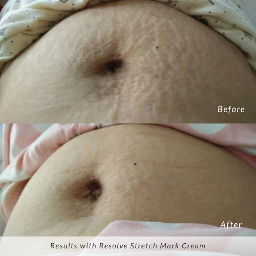 Resolve-Before-and-After-Stretch-Marks