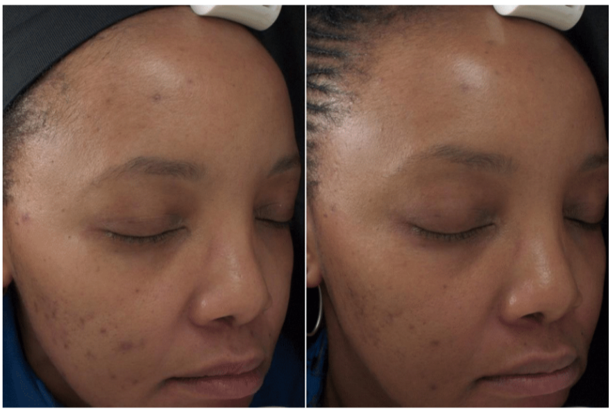 12weeksbrighteningserumparticipant3