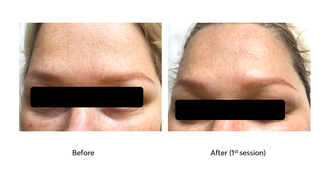 Caviar-Nourishing-Therapy-Before-After-1-Session-4