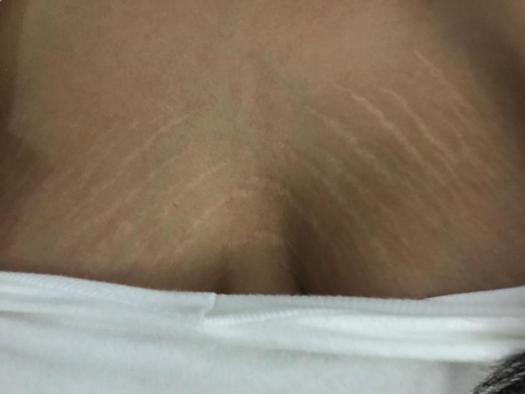 decolleteAFTERstretchmarkcreme