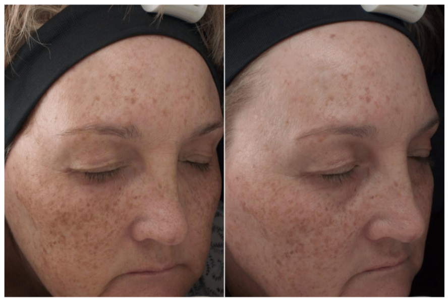 12weeksbrighteningserumparticipant4