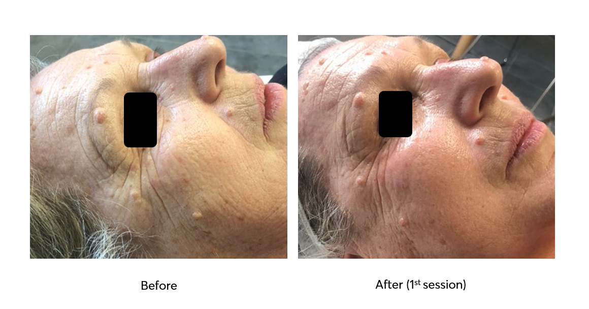 Caviar-Nourishing-Therapy-Before-After-1-Session