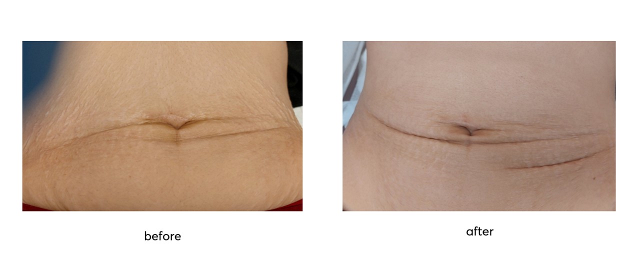 Phytopeeling-Body-Therapy-Before-After-3-Sections-on-2nd-3rd-section-fruit-acids-20-ApocalypsisflNRdoyfXbBeC