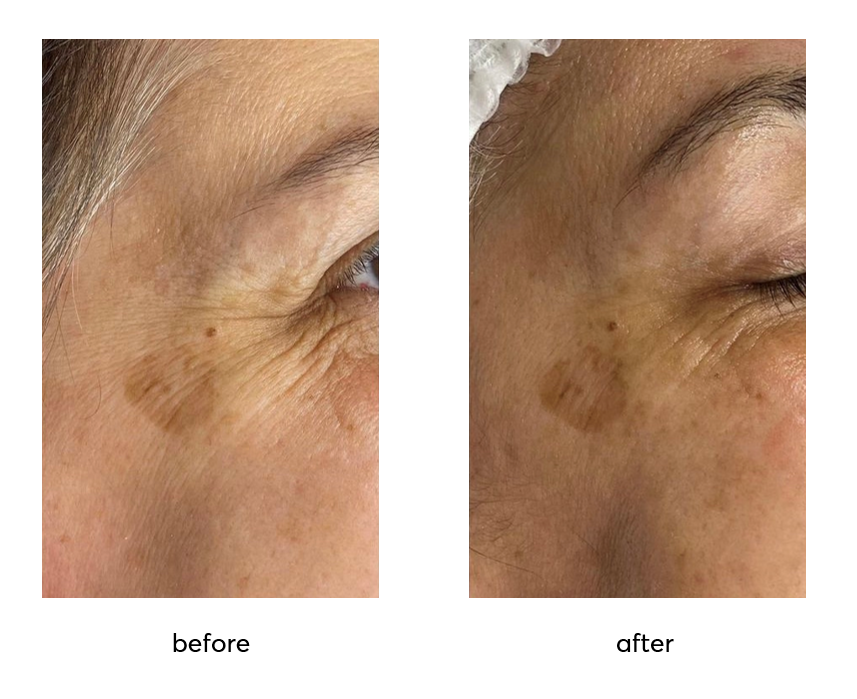 Rejuvin_Before-After-1-Application