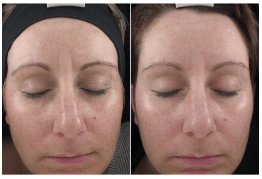 12weeksbrighteningserumparticipant2