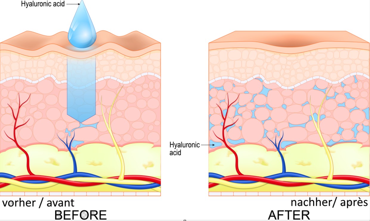 Hyaluronsäure, Hautdiagramm, Epidermis, Dermis, Ansicht/Illustration