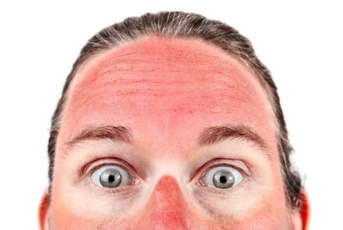 Gesicht, Rötung, Stirn, Haut, Augen