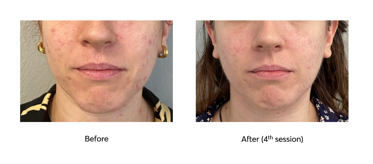 Ameson-Mesopeel-Pure-Skin-Before-After-4-Sessions
