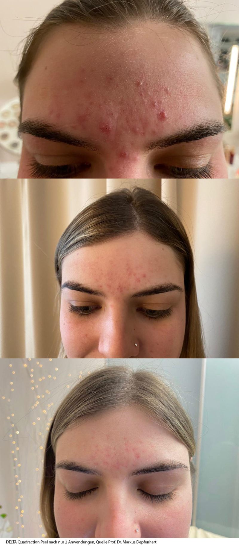 quadrationpeelaufAKNE