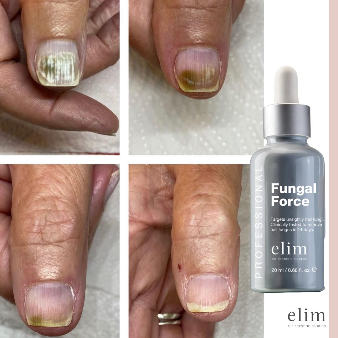 fungal-force-in-9-weeks