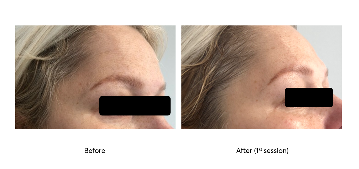 Caviar-Nourishing-Therapy-Before-After-1-Session-6