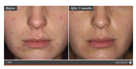 treatmentenvironclarityplus-juvenileacne90days