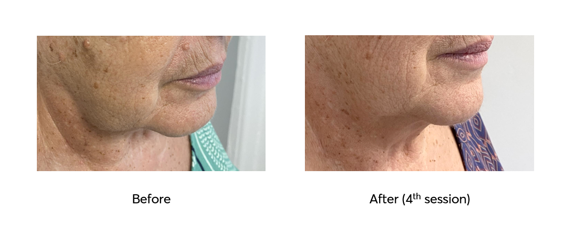 Ameson-Mesopeel-Rejuvenation-Before-After-4-Sessions