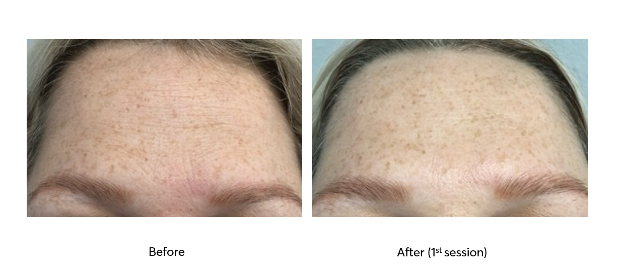 Caviar-Nourishing-Therapy-Before-After-1-Session-3