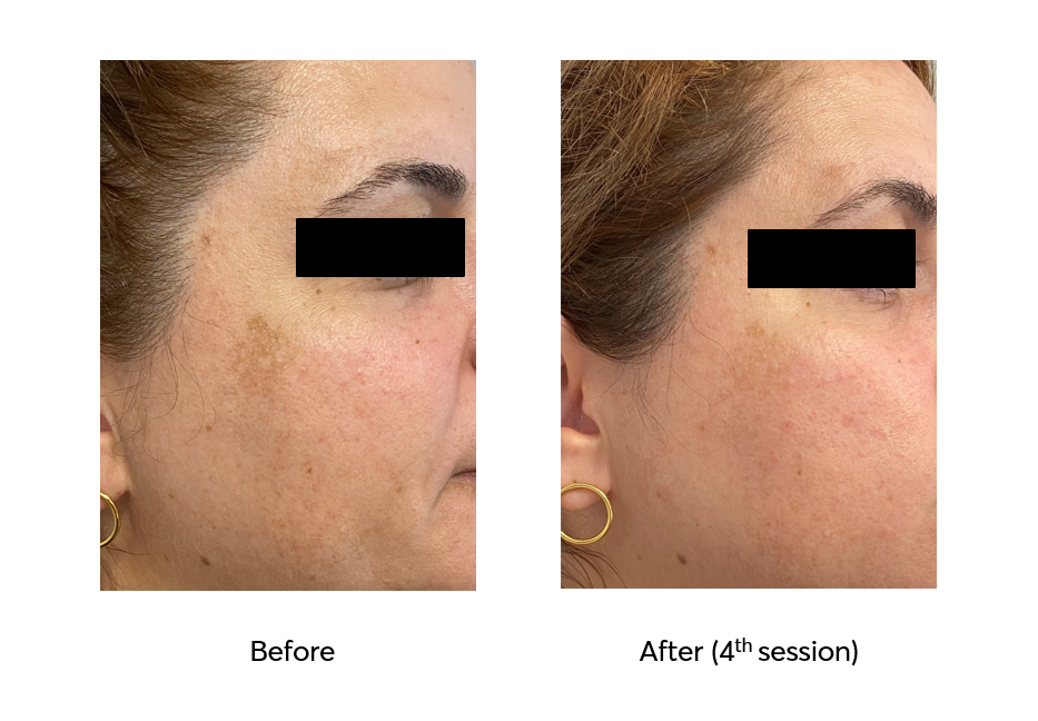 Ameson-Mesopeel-Bright-Skin-Before-After-4-Sessions