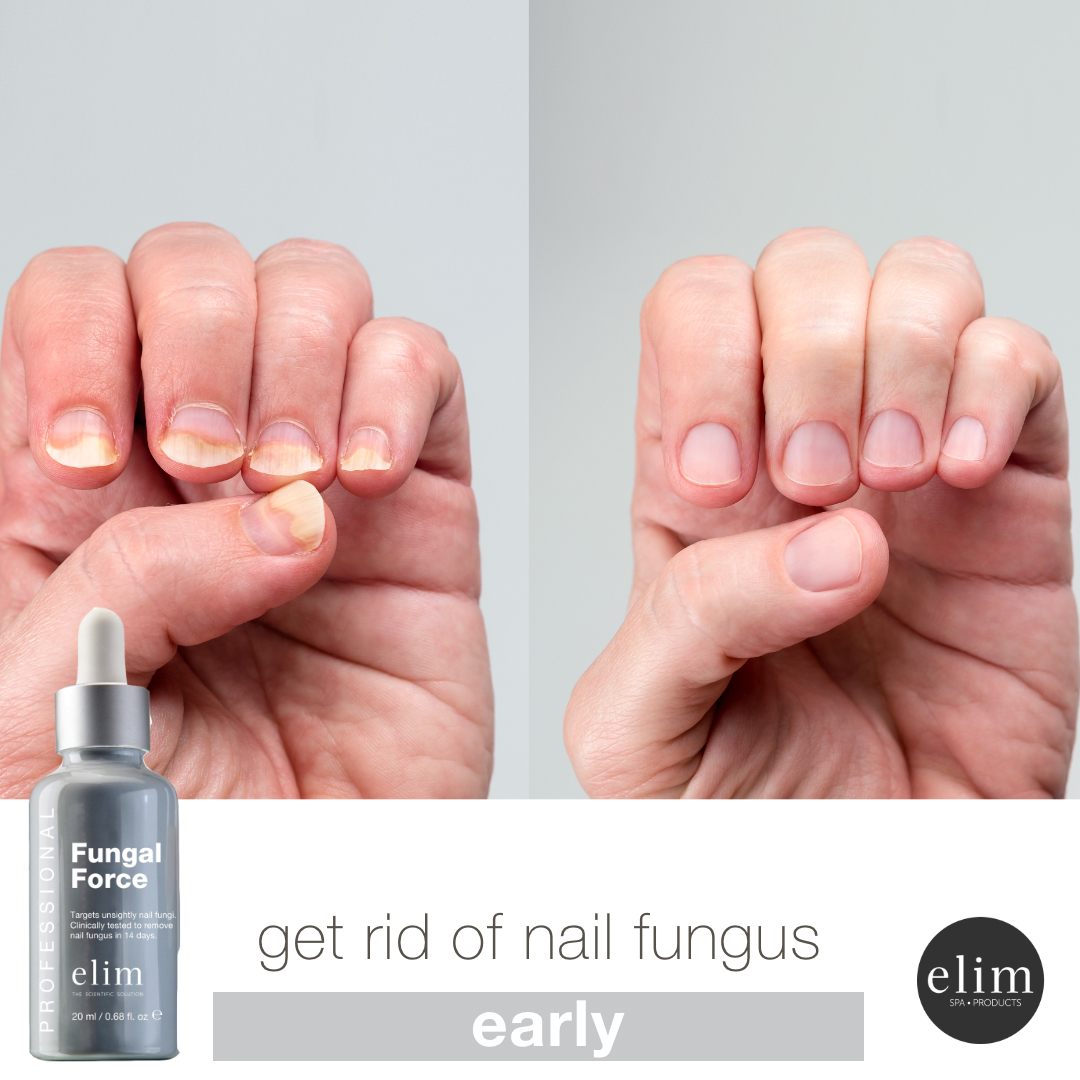 fungal-force-nail-fungus-elim-spaproducts