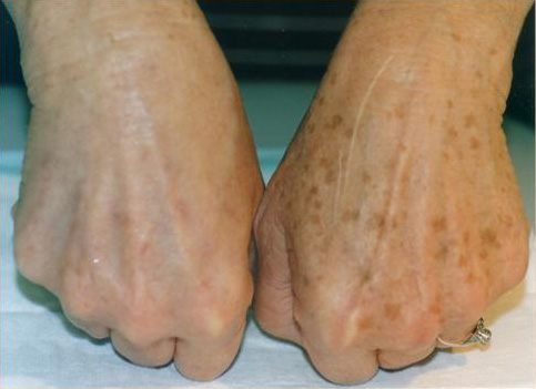 hand-Pigmentation
