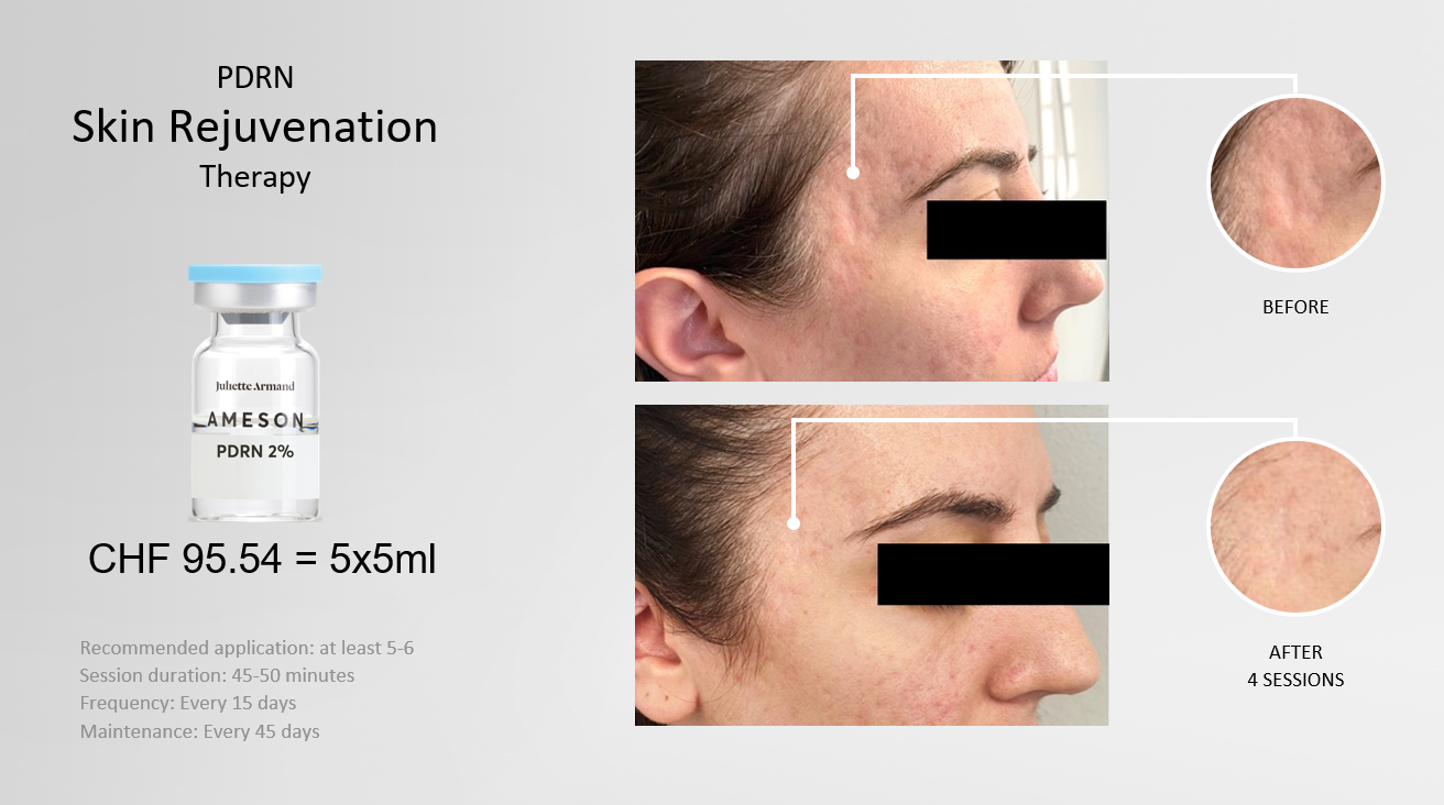 PDRN2 PdRN 2% Rejuvenation Serum 5x5ml Anti-Ageing AMESON