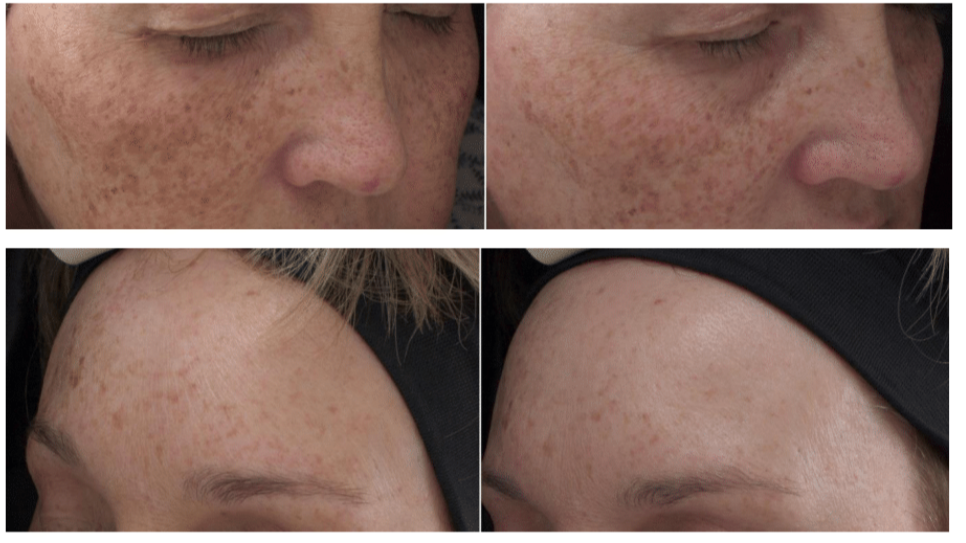 12weeksbrighteningserum