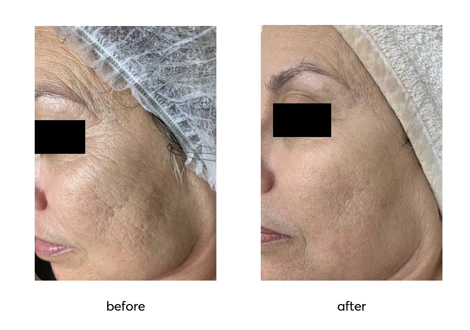 Argireline-Leuphasyl-10-Rejuvin-Before-vs-After-2