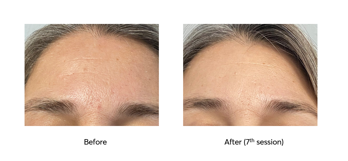 Ameson-Mesopeel-Rejuvenation-Before-After-7-Sessions