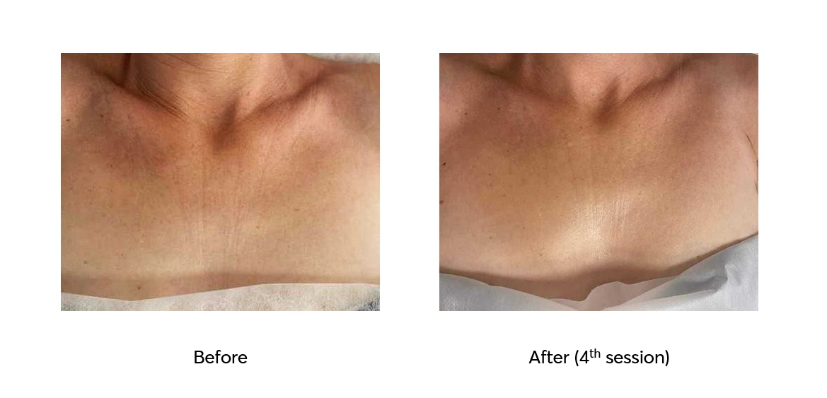 Ameson-Mesopeel-Bright-Skin-Before-After-4-Sessions-bustTnrct9IoAYjRU