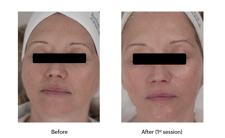 Caviar-Nourishing-Therapy-Before-After-1-Session-7