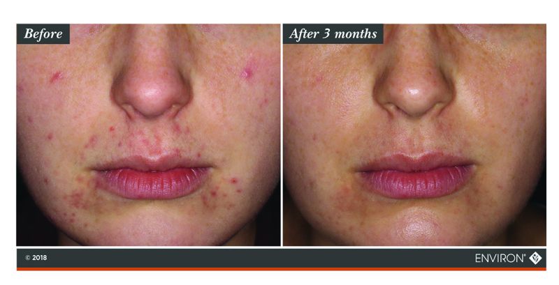 juvenileacne90days