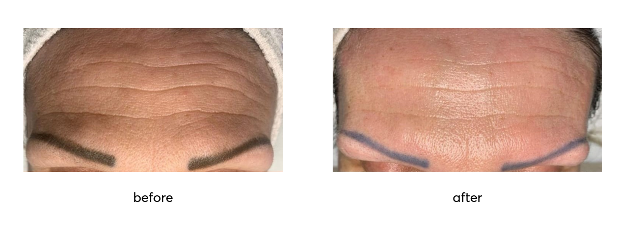 thavma-therapy-before-after-Cyprus