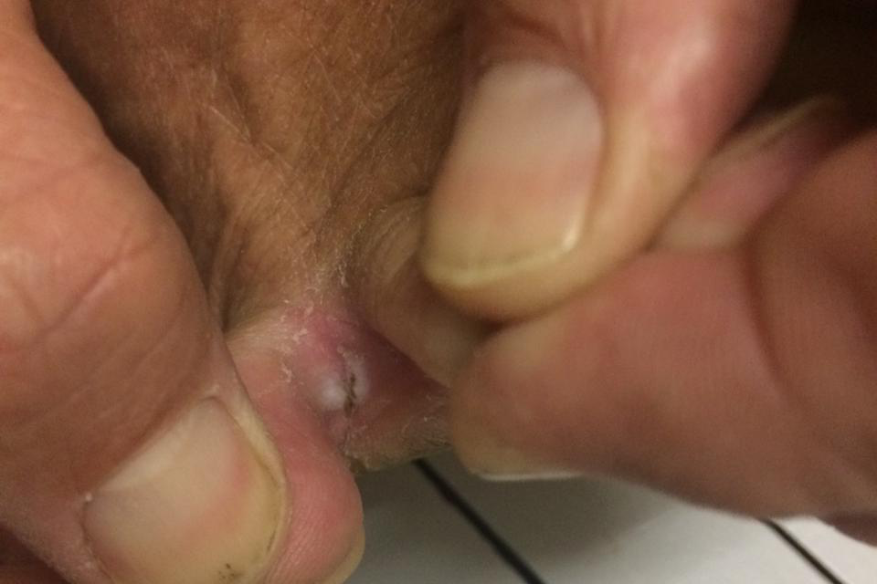healed-fungal-infection-5-days