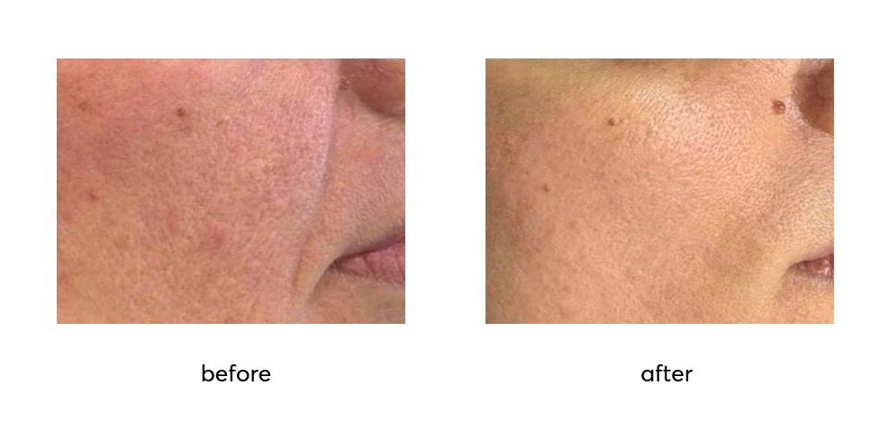 Rejuvin-before-after-5-sessions