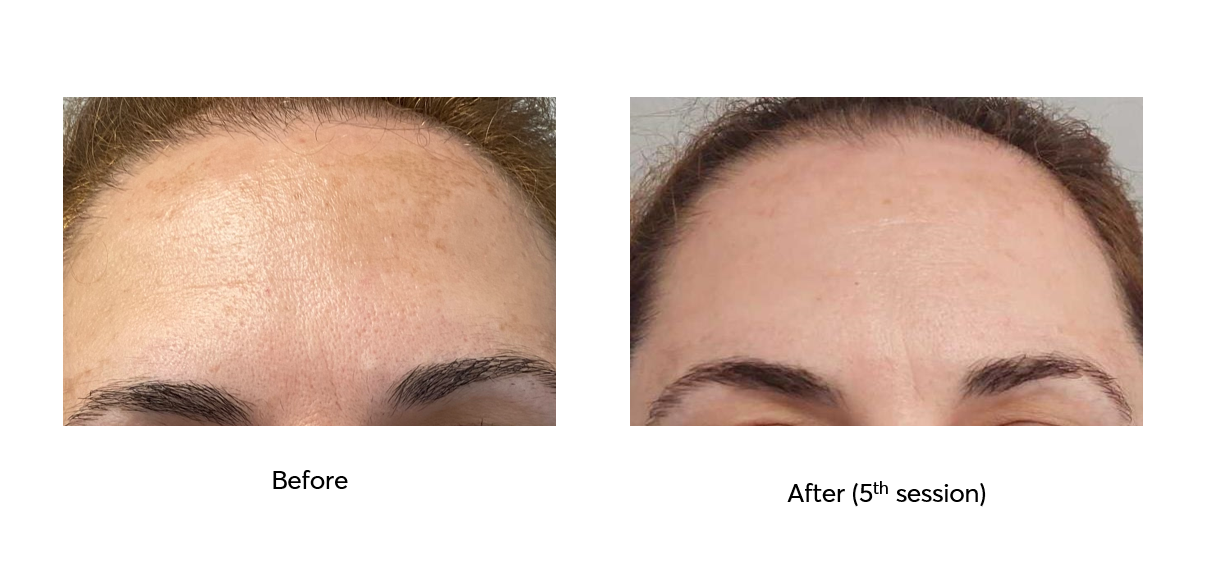 Ameson-Mesopeel-Bright-Skin-Before-After-5-Sessions
