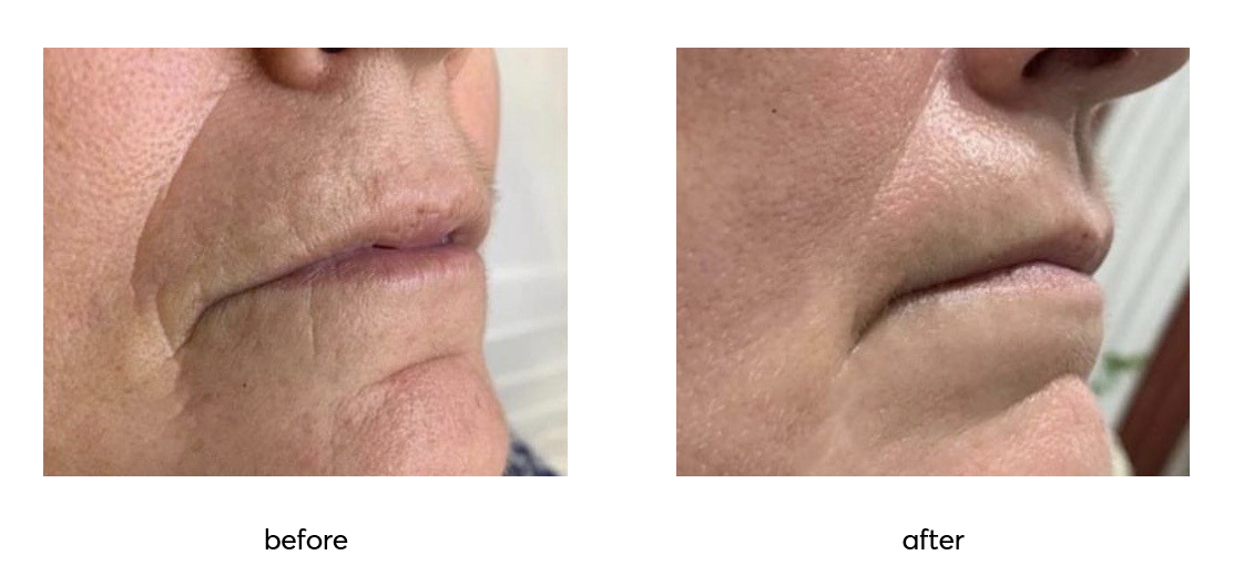 Argireline-Leuphasyl-10-Rejuvin-Before-vs-After