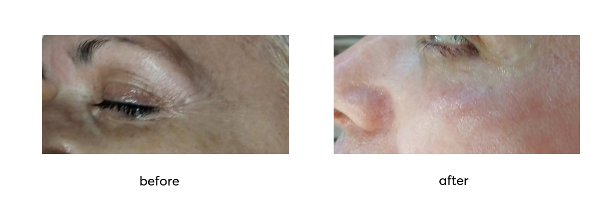 Rejuvin_Before-After-3-Applications_1