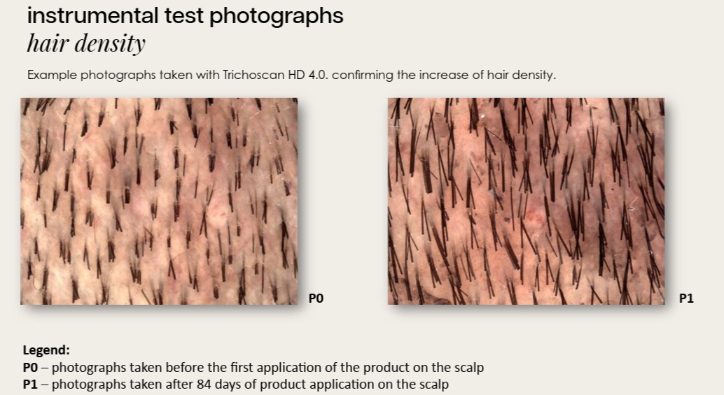 scalp, Haardichte, Stoppeln, Follikeldichte, Haare auf der Kopfhaut