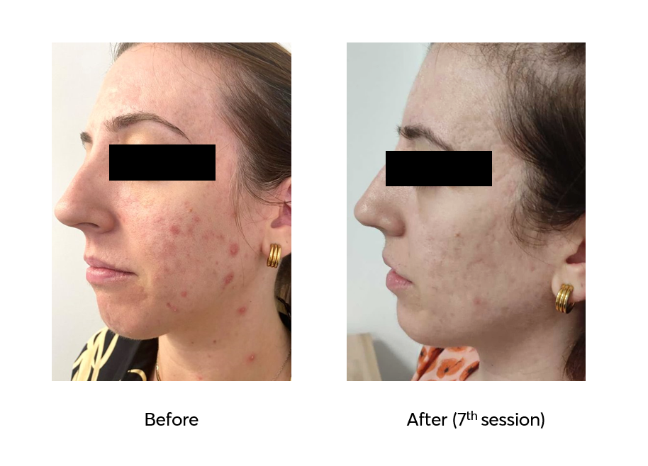 Ameson-Mesopeel-Pure-Skin-Before-After-7-Sessions