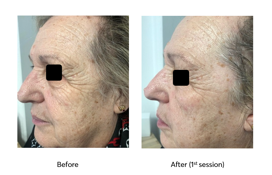 Caviar-Nourishing-Therapy-Before-After-1-Session-2